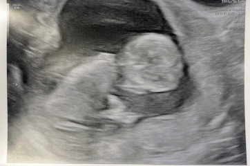Any nub experts? Awkward scan position!