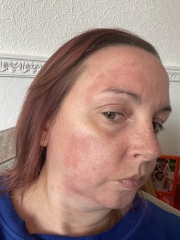 Please help identify this rash