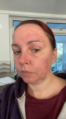 Please help identify this rash