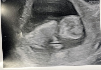 Any nub experts? Awkward scan position!