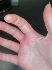 To ask about hives and swollen fingers. 