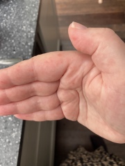 PICTURE: Wtf are these painful bumps on my hands and fingers? 