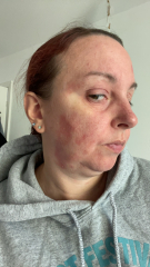 Please help identify this rash