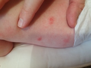 Larger red spots on 6 month old babies back