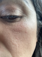 Does this look like Rosacea?