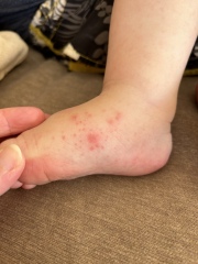 Abroad and need help identifying rash