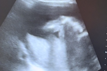 Any ultrasound techs here ? Is this a potty shot?