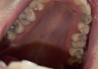 Gross pic I'm sorry, but wtf has happened to my teeth?