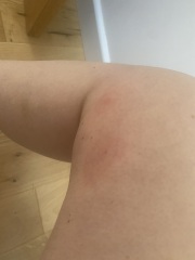 False widow bite - 7 days on