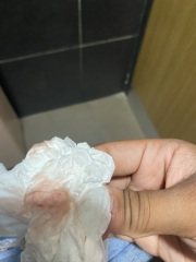 Implantation bleeding
