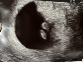 Did they see anything on your early scan?