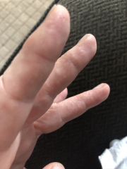 PICTURE: Wtf are these painful bumps on my hands and fingers? 