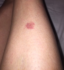 Red patches under skin