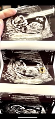 Girl or Boy Nub in Scan