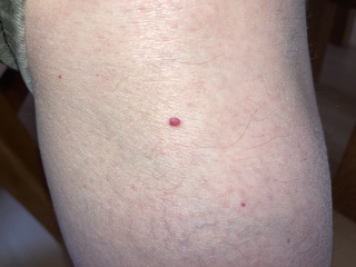 Petechiae or cherry angioma? Talk me down