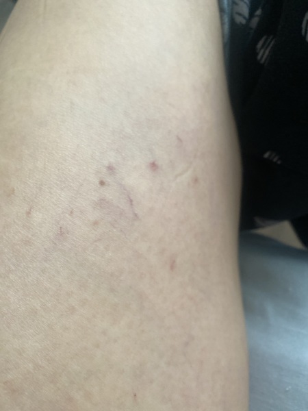 Spider/Thread veins on legs