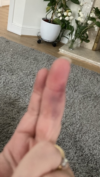 Achenbach syndrome - help, please!