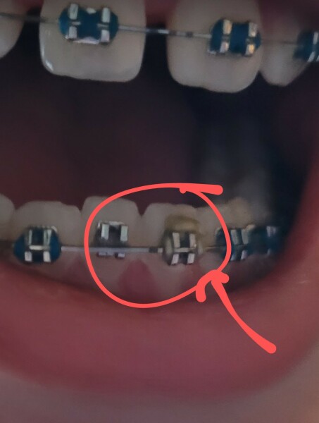 Anyone know what this part of a brace is called?