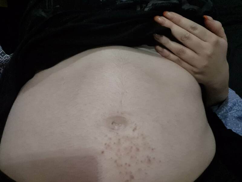 Diastasis recti?
