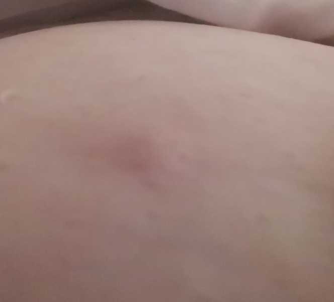 Do I bother the GP with this, lump in breast