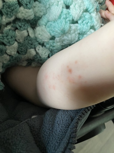 Baby rash