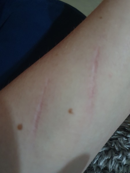 Scars - is there any way of getting rid? 
