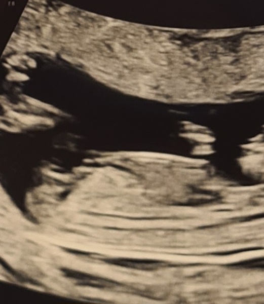 Nub theory - is there any chance this isn't a boy?