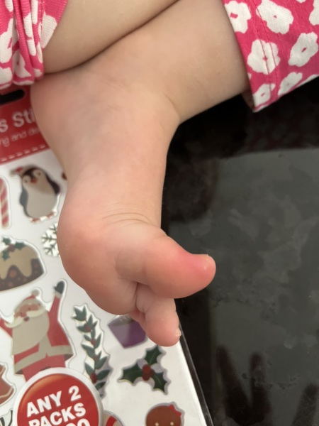 Whitehead or abscess on child's big toe?