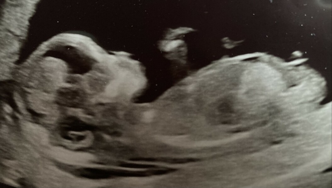 Guess gender with nub at 13 weeks