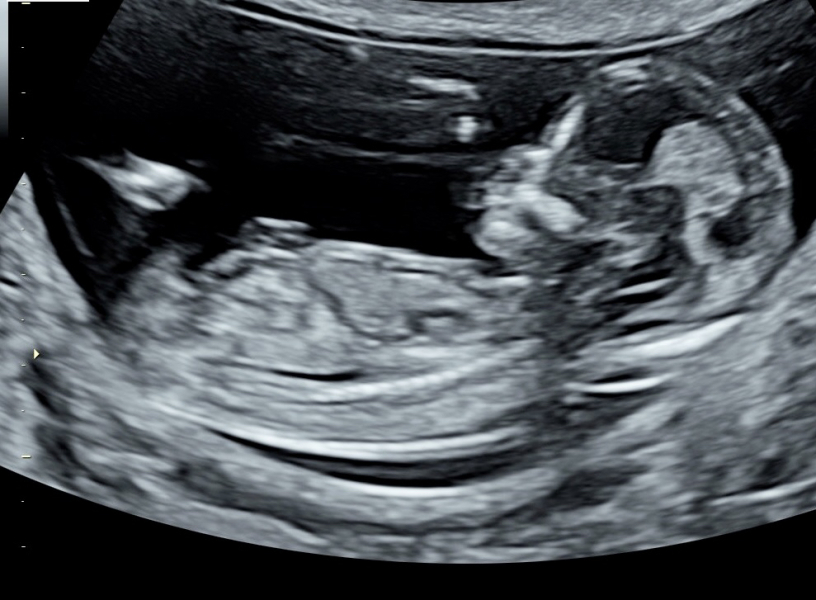 13 week 3d pic - boy or girl??