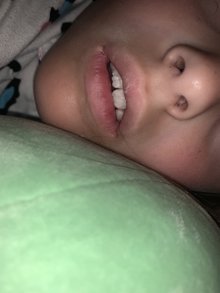 white patches on new adult teeth? 