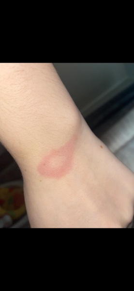 Ringworm or Lyme disease?