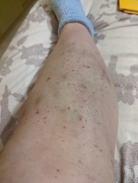 Unwell with spots