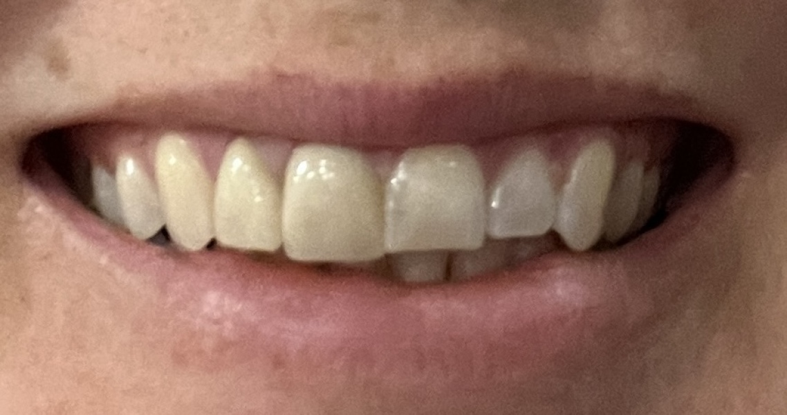 So low about smashing my front tooth up