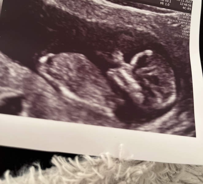Gender Guesses - Boy or Girl?