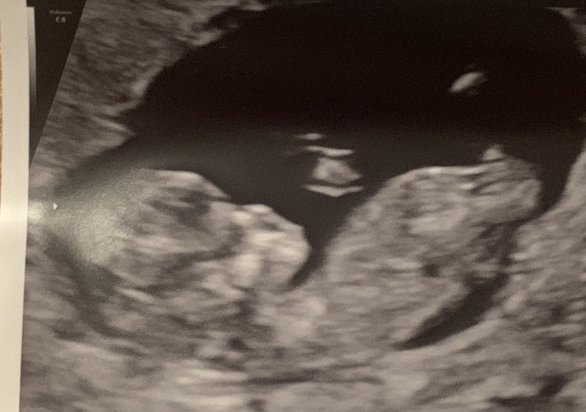 Just for fun - boy or girl?