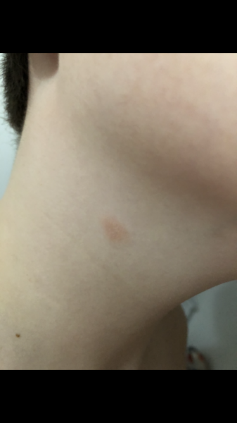 Could this be ringworm? 