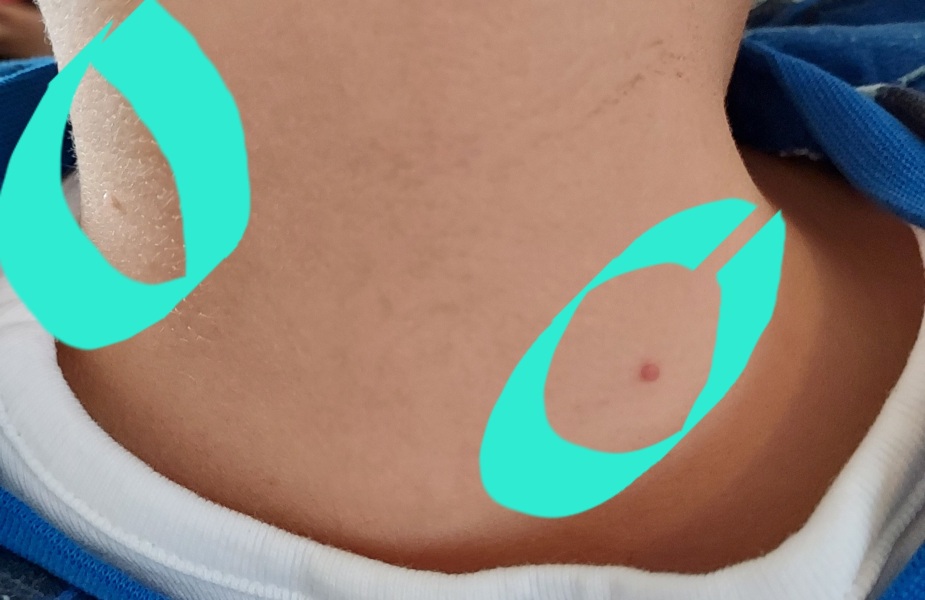Start of chicken pox?
