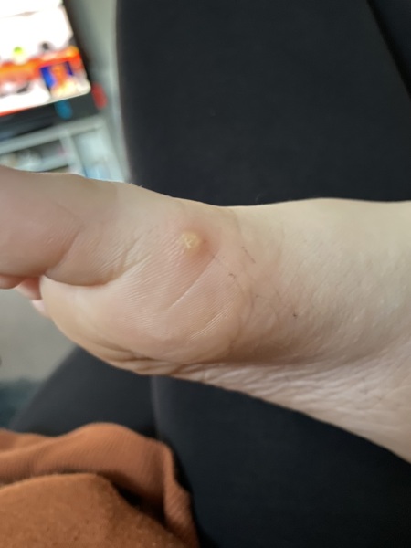 Spot on 7 year olds foot