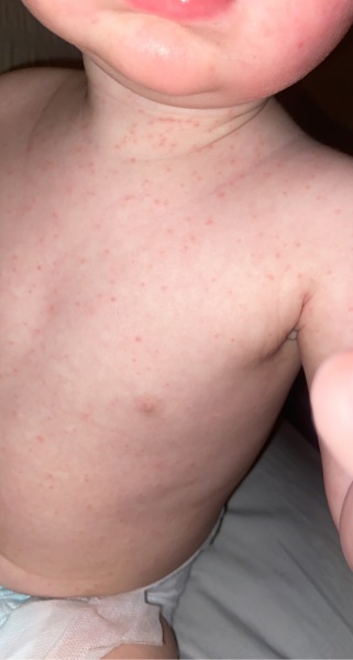 What does this rash look like?