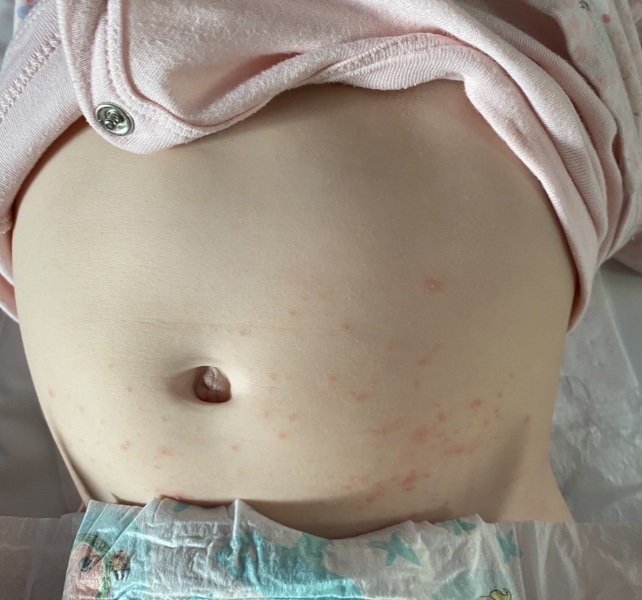 Chicken pox or not??