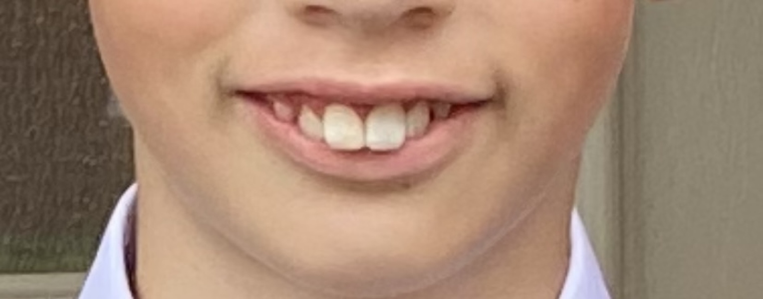 Twin Block Braces - Any Advice?