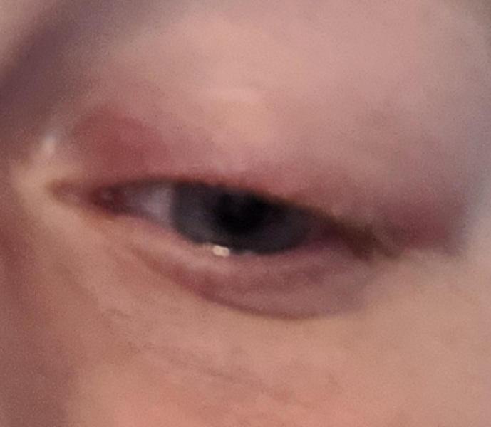 WTH wrong with my eye?