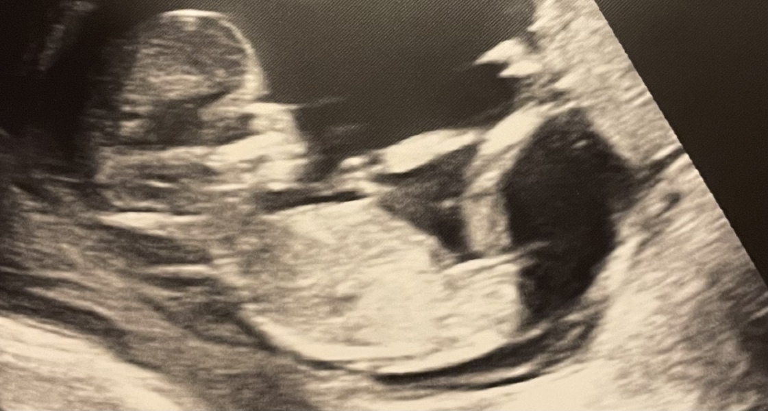 Nub theory guesses please! 13w5 scan