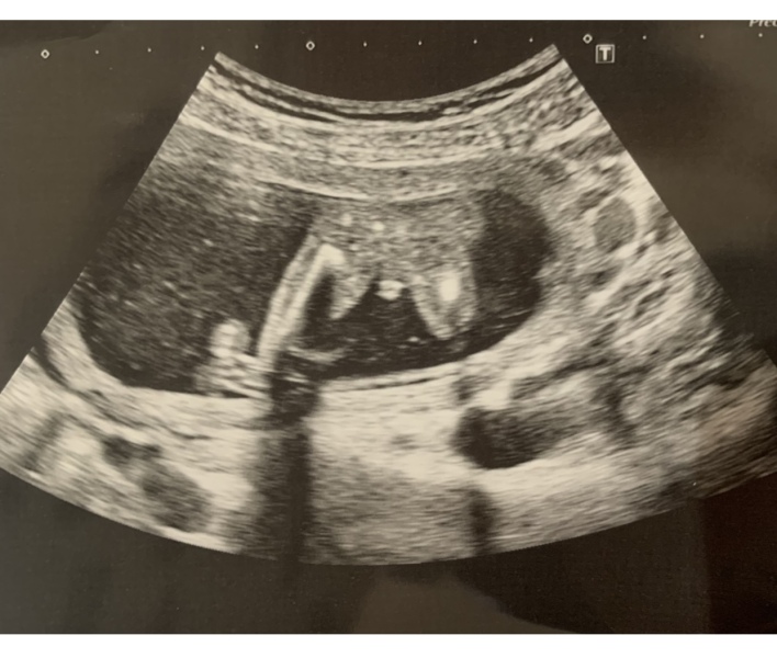 Potty Shot! Girl or Boy? 
