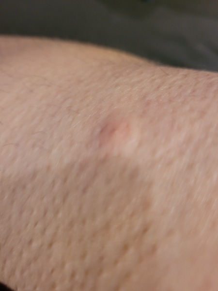 What the hell keeps biting me?!