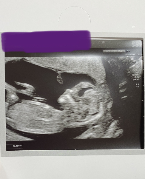 Pregant after miscarriage - support thread