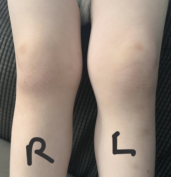 Swollen knee in toddler?