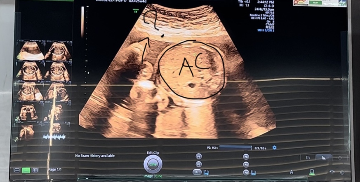 Recorded Video While Anomaly Scan