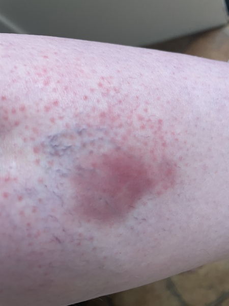 Could this be a blood clot? 